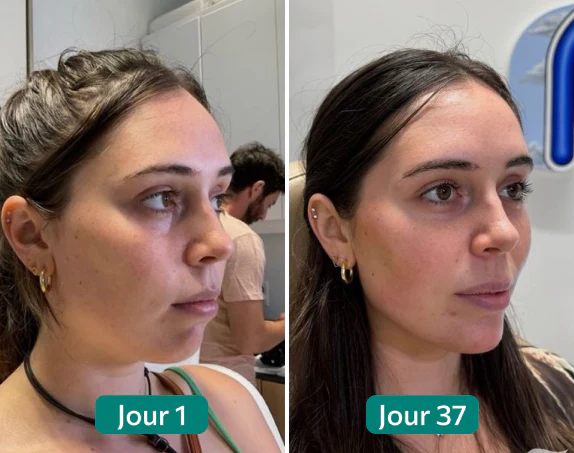 Laura C. : deux photos de profil, libellées Jour 1 et Jour 37 dans le visuel original publié chez Nuclever.