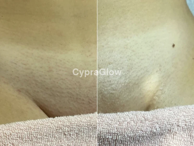 Comparaison avant/après — Emma R.